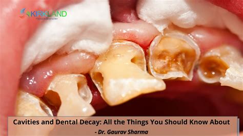 Cavity And Dental Decay Kirkland Premier Dentistry