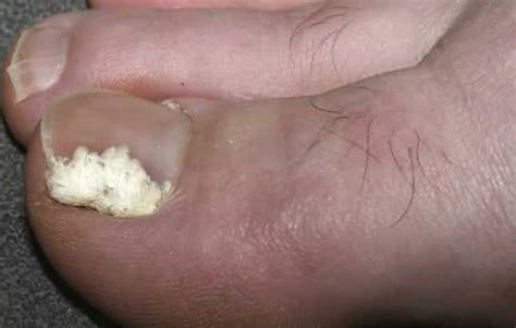 White Spots On Toenails Meaning Fungus Pictures After Pedicure