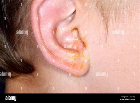 Outer Ear Infection Close Up Of Pus Discharging From The Ear Of A 5