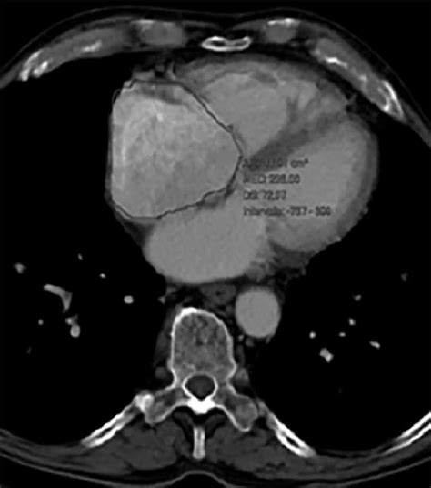 Axial Chest Computed Tomography Showing A Dilation Of The Right Atrium