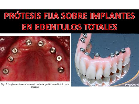 PrÓtesis Fija Sobre Implantes En Rebordes EdÉntulos Totales Por La Dra Diana Esparza Youtube