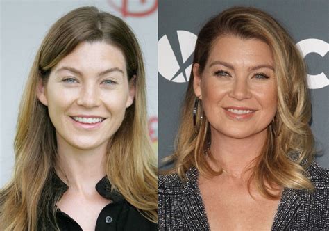 Ellen Pompeo Lip Scar