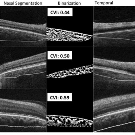 Choroidal Vascularity Index In All Eyes Download Scientific Diagram