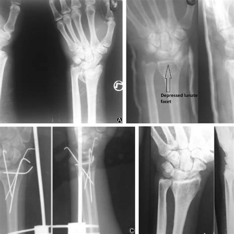 Lunate Fossa Die Punch Distal Radius Fracture On A 30 Years Old Male