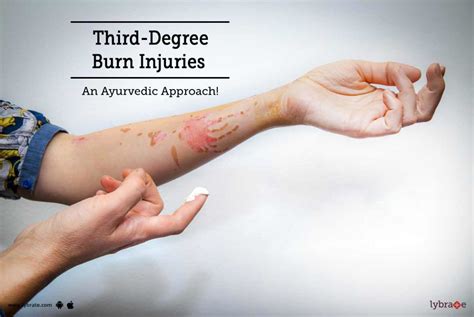 Third Degree Burn Injuries An Ayurvedic Approach By Dr Sumit