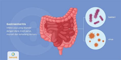 Gastroenteritis Gejala Diagnosis Pengobatan