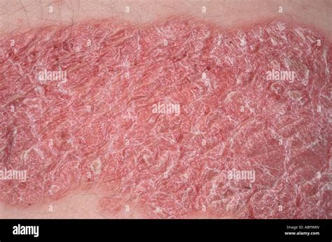 Psoriasis Plaques Hi Res Stock Photography And Images Alamy