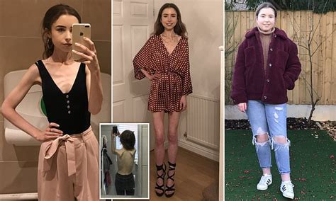 Anorexia Survivor Who Consumed Just Calories A Day And Dropped To St Has Gained St In