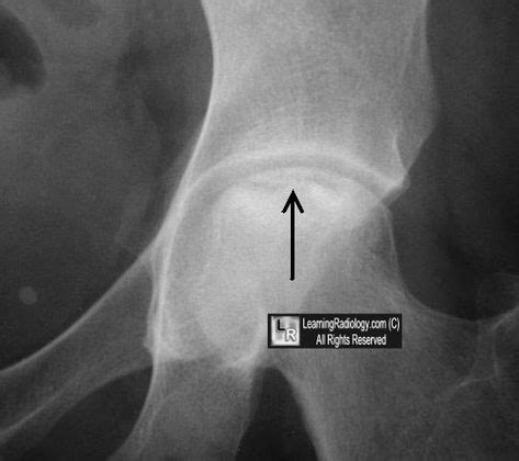 Crescent Sign Subarticular Lucency In Femoral Head Stage Avn