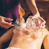 Pictures of Cupping Glass Therapy