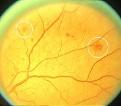  yellowish patches of lipid and protein within the retina. How to diagnose and manage diabetic retinopathy - EyeGuru
