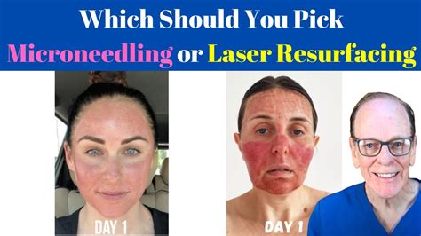 Should You Get Microneedling Or Laser Resurfacing Plastic Surgeons Advice Youtube