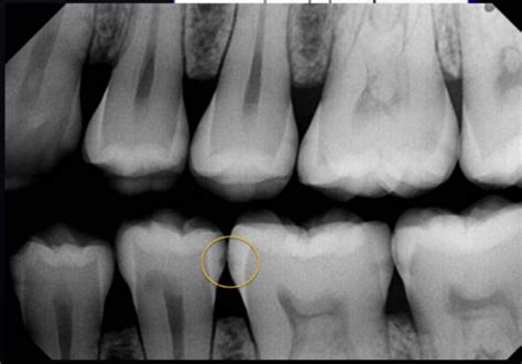 Radiographic Lesions In Dental Caries Flashcards Quizlet