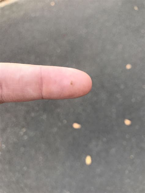 A huge blackhead from my back! Never had such a large one before! I