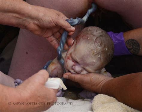 Graphic Photos Of Breech Birth Aim To Spread Knowledge About Normalcy