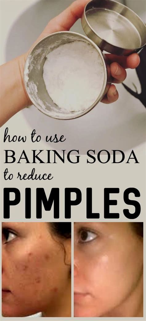 Pin By Kalitkinamiloslava On Skin Care How To Reduce Pimples Baking