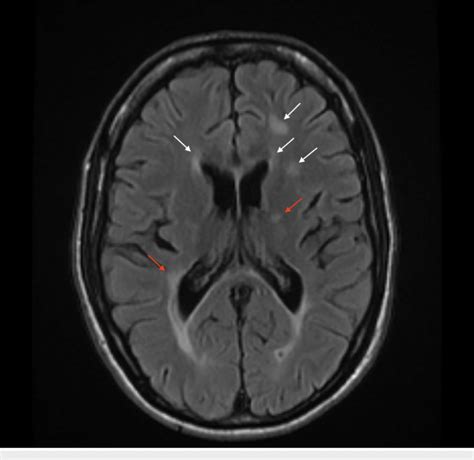 Axial T2 Flair Magnetic Resonance Imaging Mri Of The Brain Revealing