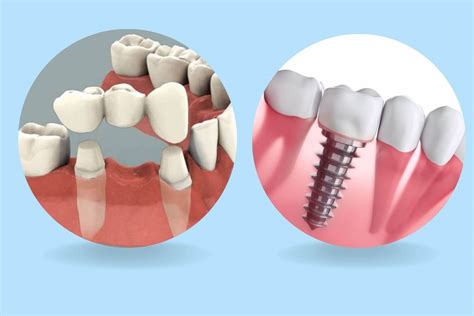 Ventajas De Los Implantes Dentales Contra Puentes Dentales