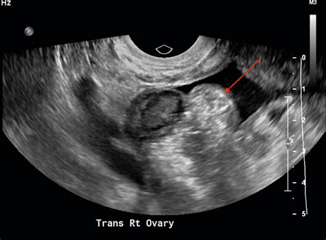 Transvaginal Pelvic Ultrasound Lecture Youtube Radiography My Xxx Hot