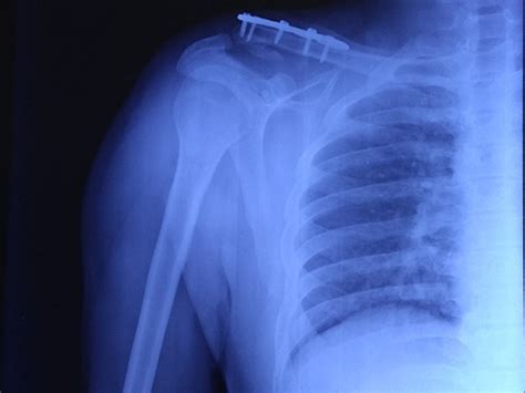 Cureus Clinical Outcome Of Neer Type Ii Lateral End Clavicle