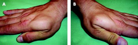The muscles' names reflect their actions on the digits. Bilateral idiopathic hypertrophy of the first dorsal ...