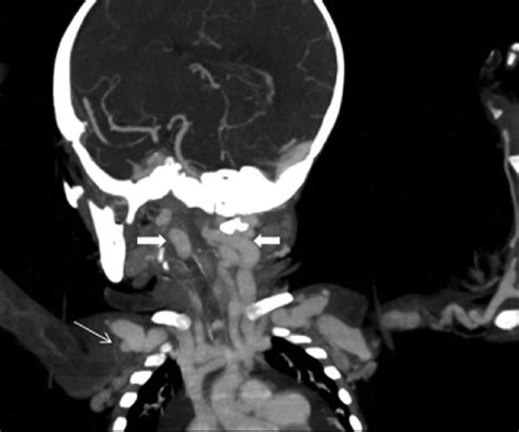 Ct Angiography Coronal Mip Image Shows Dilated Bilateral Subclavian