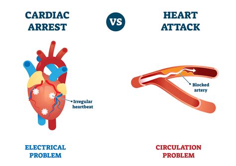 Cardiac Arrest Vs Heart Attack Capital Heart Centre