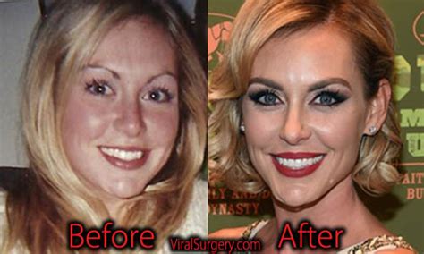Jessica Robertson Plastic Surgery Before After Facelift Botox Pictures