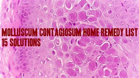 The Ultimate Molluscum Contagiosum Home Remedy List 15 Solutions