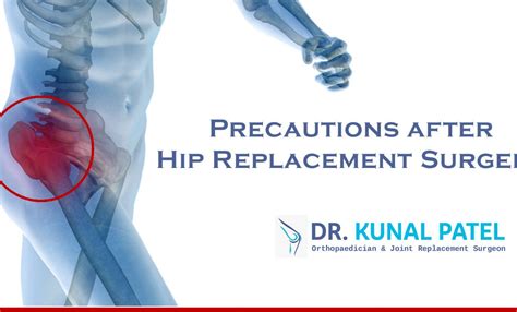 Precautions After Hip Replacement Surgery By Dr Kunal