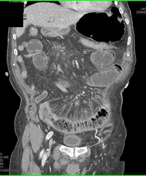 Distal Small Bowel Obstruction With Ischemic Bowel Small Bowel Case