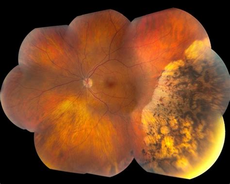 Pigmented Peripheral Retinal Degeneration Retina Image Bank