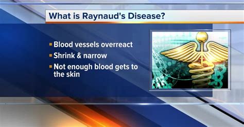 What You Need To Know About Raynauds Disease