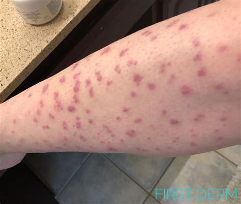 Life Threatening Skin Rashes Online Dermatology