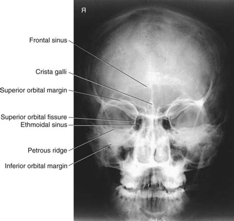 Speak to your doctor on any concerns that you have. Skull, Facial Bones, and Paranasal Sinuses | Radiology Key