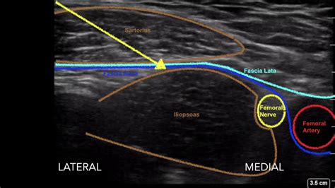 Ultrasound Guided Femoral Nerve And Fascia Iliaca Block Youtube
