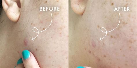 Reviewed I Tried The Killa Cystic Acne Patches How To Treat Cystic