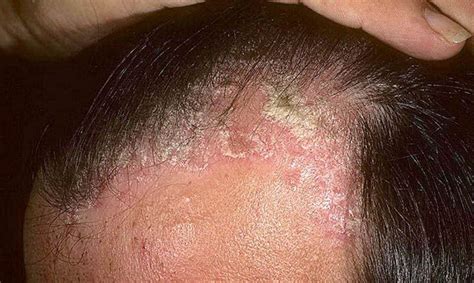 Scalp Psoriasis Images Symptoms And Pictures