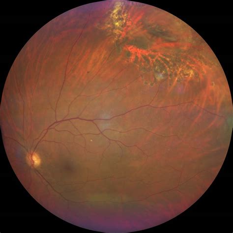 What are retinal tear symptoms? HD Retinal Photographic Imaging - the new Zeiss Clarus ...