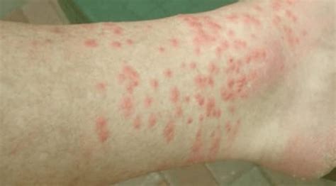 Itchy Bumps That Look Like Mosquito Bites But Arent Pestseek