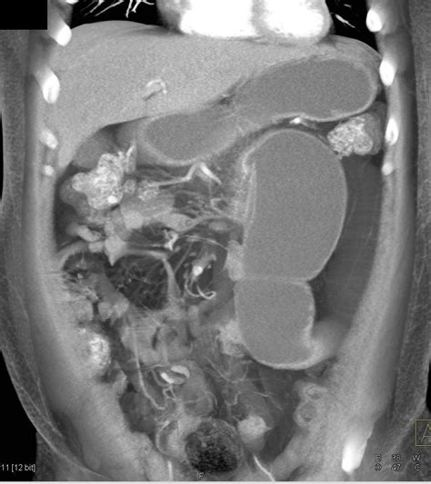 Small Bowel Obstruction Sbo Due To Crohns Disease With Narrowed
