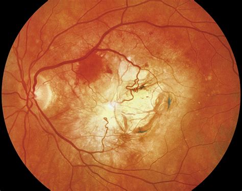 Learn How To Diagnose And Monitor Amd Using Oct Ophthalmology Advisor