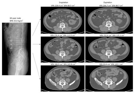 Clinical Significance Of Visceral Adiposity Assessed By Computed