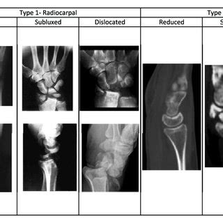 Carpal Fractures Associated With Lunate Fractures Download Scientific Diagram