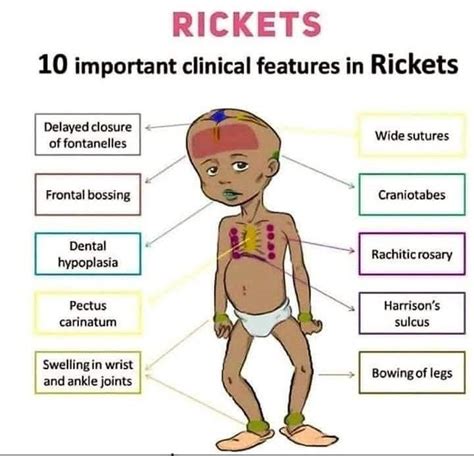 Rickets Symptoms Medizzy