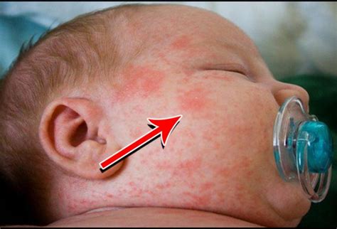 Skin Rash In Babies