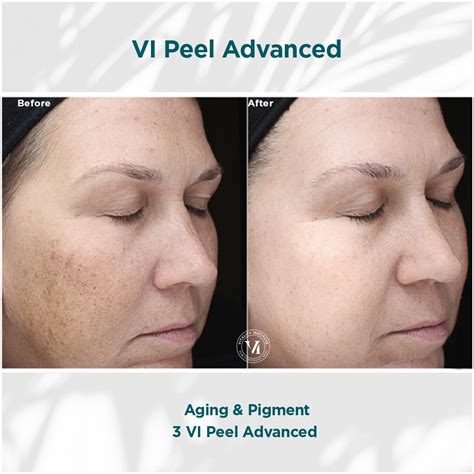 Vi Peel Before And After Photos Women First Llc