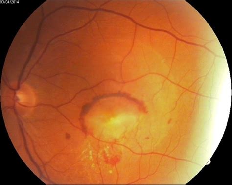 Cnv Due To Chronic Central Serous Retinopathy Retina Image Bank