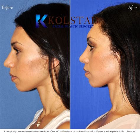 Hispanic Rhinoplasty Before And After Gallery 2 Dr Kolstad San Diego