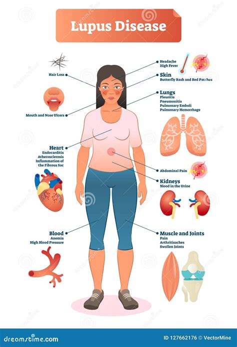 Lupus Disease Vector Illustration Labeled Diagram With Sickness